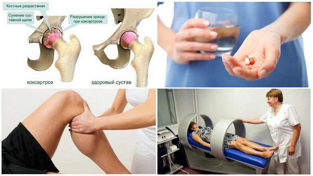 Коксартроз коленного сустава. Коксартроз тазобедренного сустава 2 обезболивающие. Коксартроз 1 степени клиника. 3. Коксартроз (клиника, диагностика, лечение).. Какие уколы при болях в тазобедренном суставе