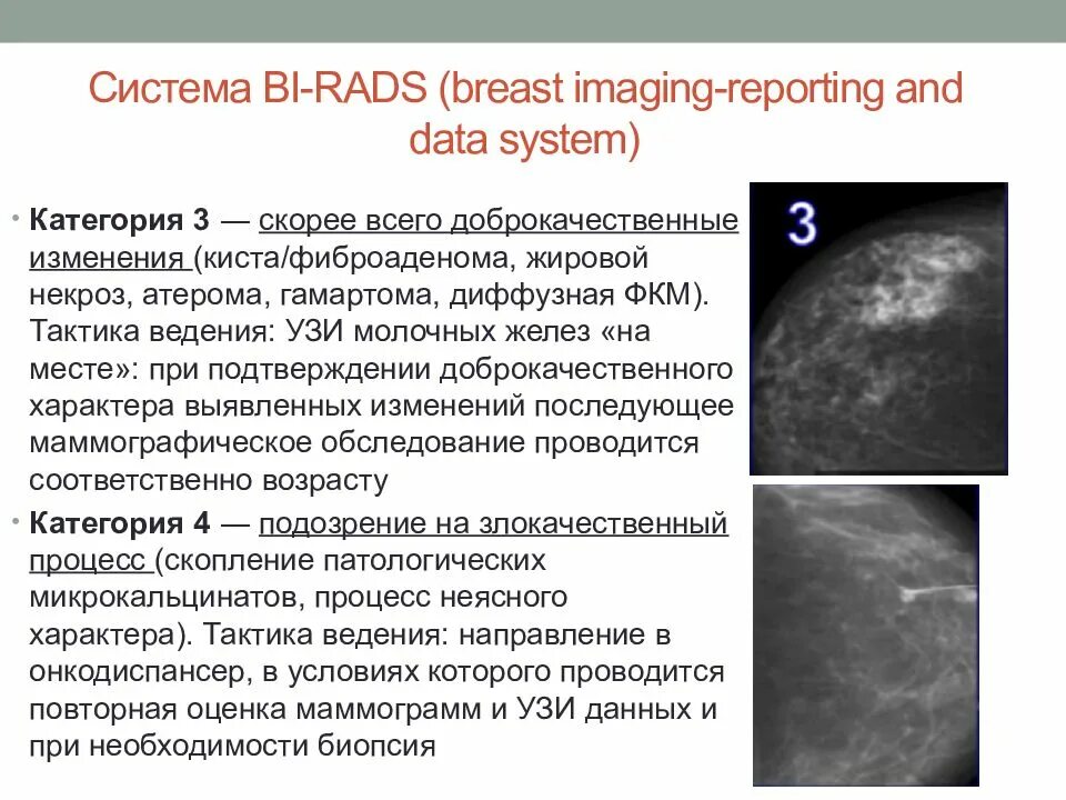 Фиброаденома молочной железы bi-rads 3. Bi-rads 3 молочной железы маммограмма. Birads 2 молочной железы что это такое. Классификация birads маммография.