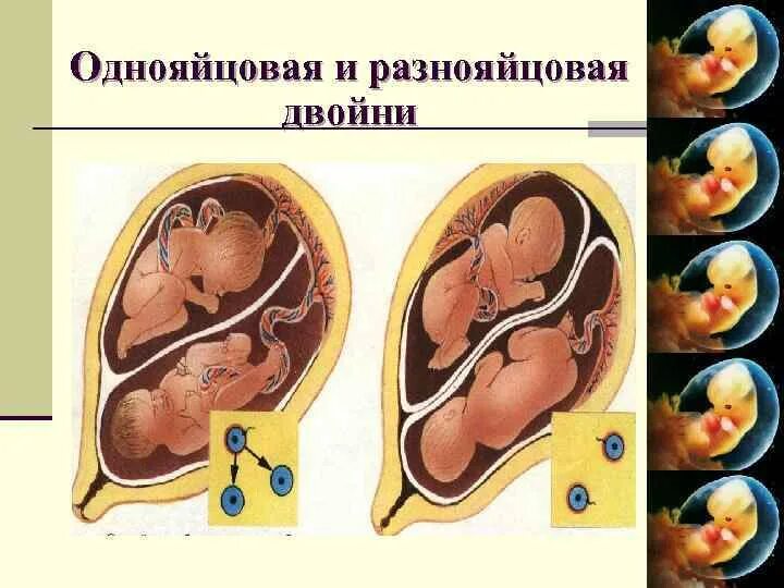 28 недель двойней. Многоплодная беременность. Редукция плода при двойне.