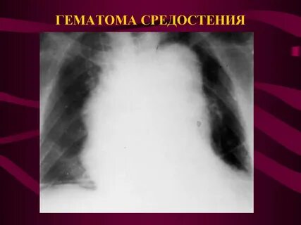 Расширенная средостения