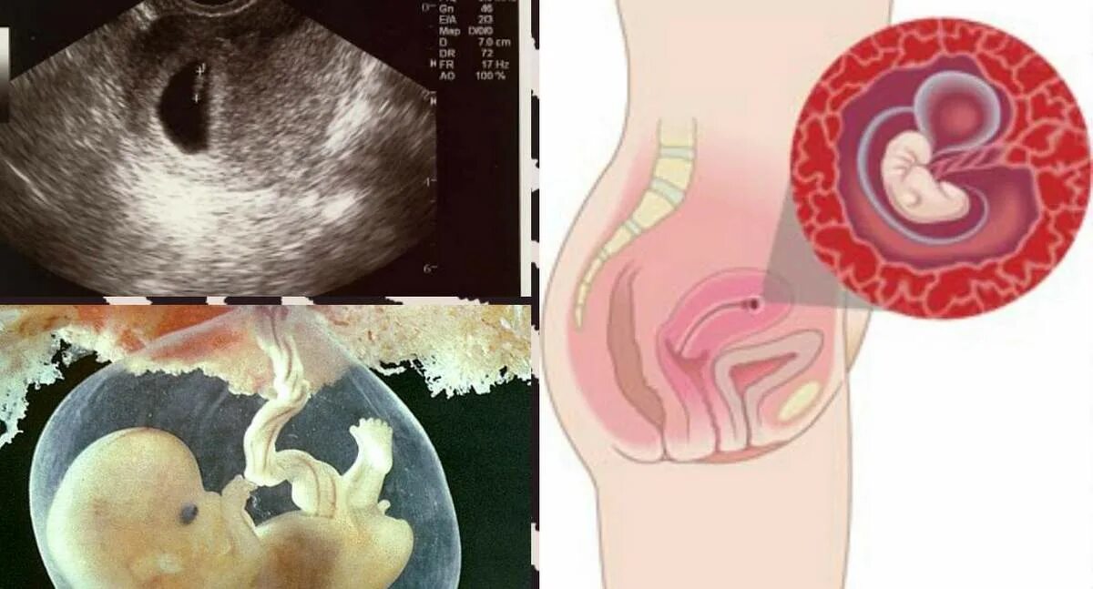 Эмбрион в матке 6 неделя беременности. Неразвивающаяся беременность 4 недели. 6 неделя что происходит с малышом