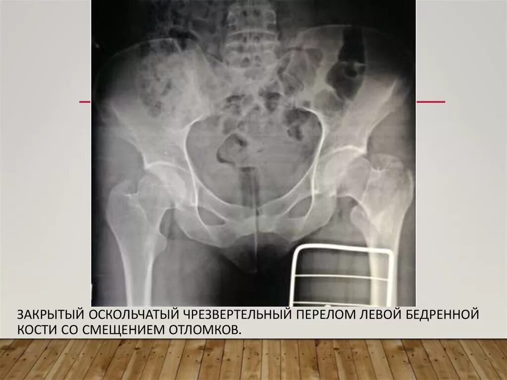 Оскольчатый со смещением. Оскольчатый перелом рентген. Оскольчатый перелом рентген. Оскольчатый со смещением. Перелом нижней трети диафиза бедренной кости рентген.