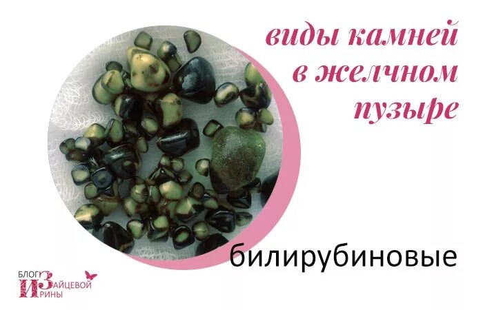 Цвет камней желчного пузыря. Билирубиновые камни в желчном пузыре. камни в желчном билирубиновые холестериновые. виды камней в желчном пузыре холестериновые. известковые камни в желчном пузыре.
