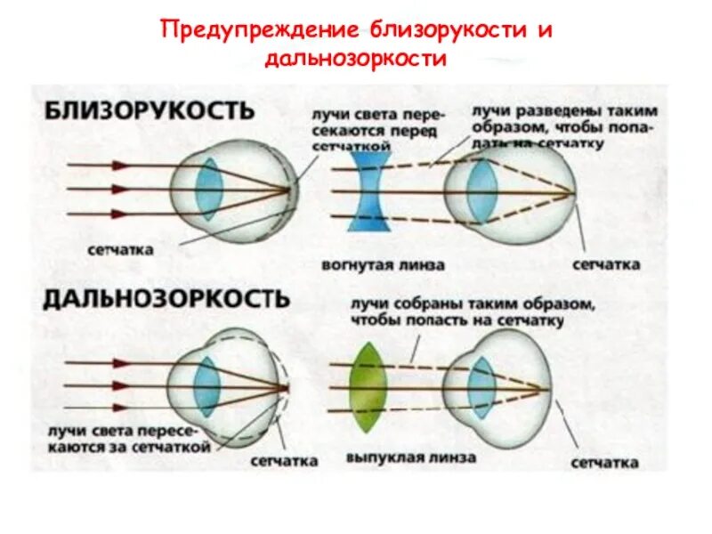 Строение глаза человека близорукость и дальнозоркость. Близорукость и дальнозоркость линзы. Дальнозоркость и близорукость строение глаза. Линзы для близорукости и дальнозоркости физика. Перед сетчаткой расположена