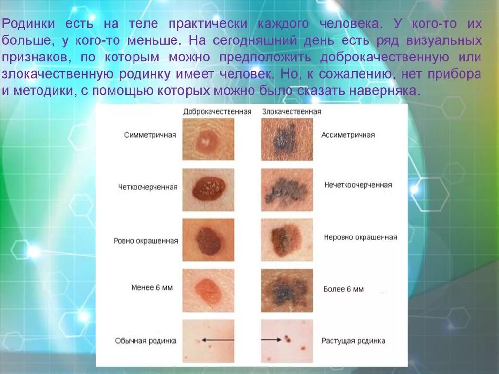 Родимое пятно значение у женщин. Формы злокачественной родинки.