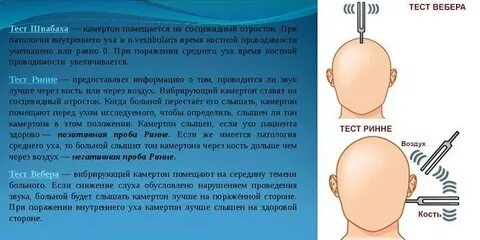 Ринне вебера