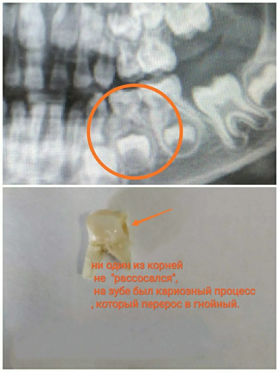 Корень молочного зуба рассасывается. Как выглядит корень молочного зуба. Молочные зубы с длинными корнями.
