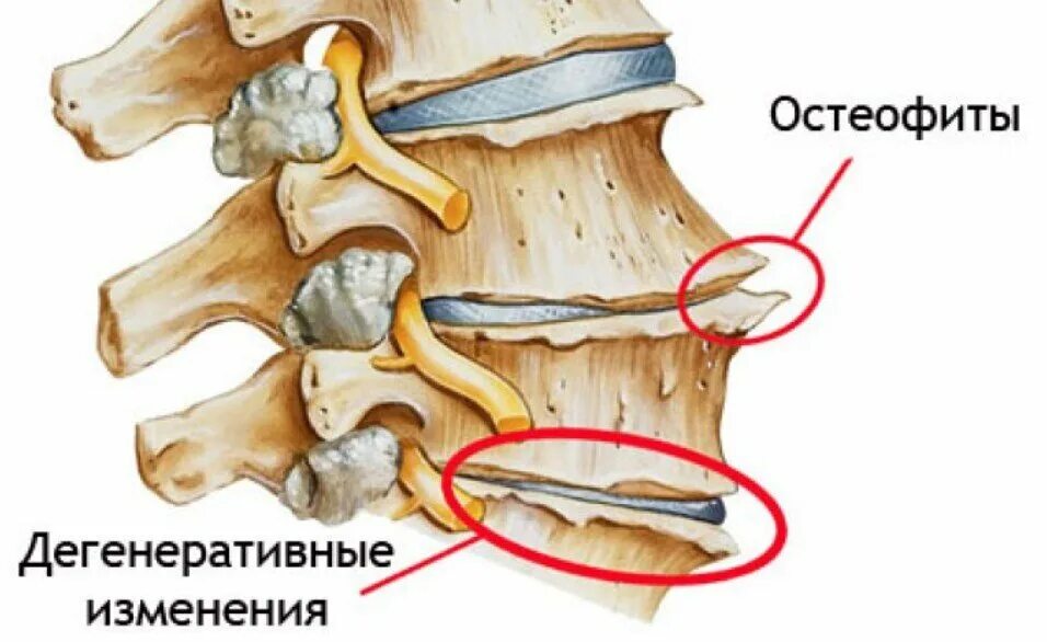 Краевые остеофиты тел позвонков поясничного отдела позвоночника. Костные остеофиты l2-s1. Остеофит пояснично крестцового отдела позвоночника. Остеофиты l4 l5 позвонков.