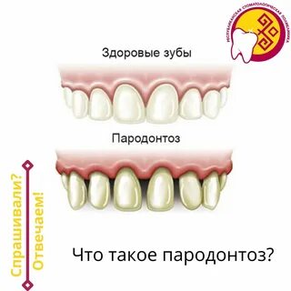 Пародонтоз лечение домашними средствами