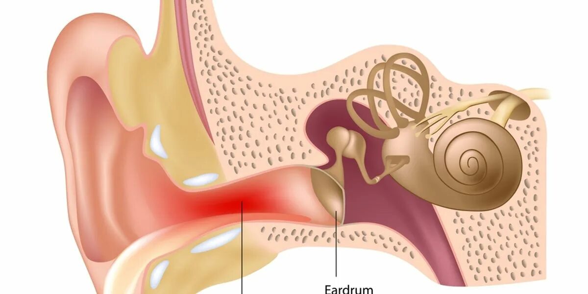 Барабанной перепонкой и внутренним ухом. Наружный отит барабанная перепонка. Отомикоз барабанной перепонки. Отомикоз серная пробка. Воспаление барабанной перепонки.