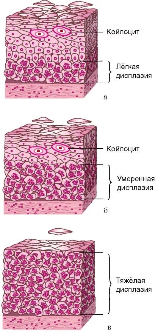 Изменения эпителия матки. Дисплазия эпителия гистология. Дисплазия 1 степени предрак?. Дисплазия эпителия 3 степени. Дисплазия шейки матки Cin 1-2.