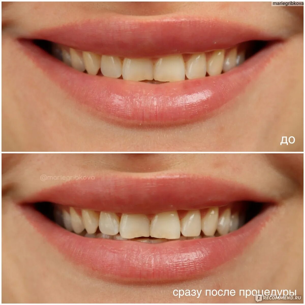 Milkmulatka. Отбеливание зубов до и после. Методики отбеливания зубов.