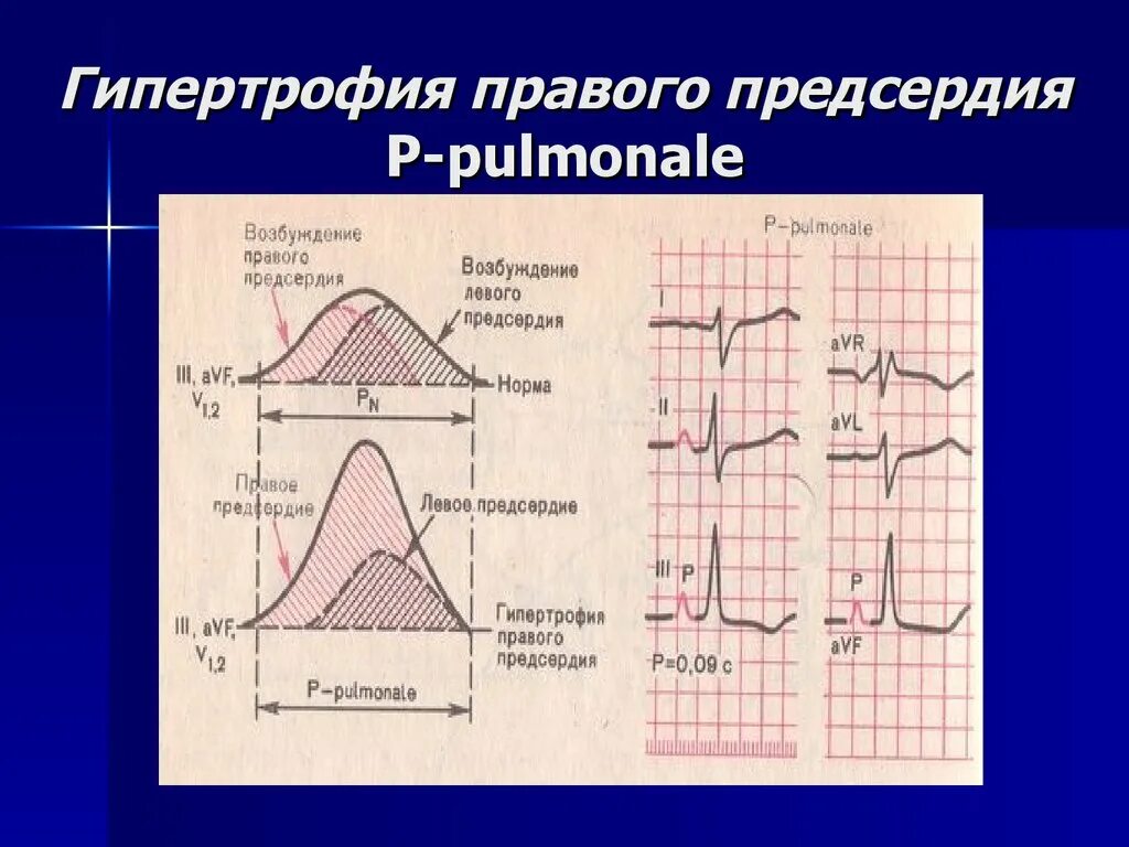 Миокард правого предсердия. Зубец р-pulmonale на ЭКГ. Гипертрофия ghfdjujпредсердия. Расширение правого предсердия на ЭКГ. Гипертрофия миокарда левого предсердия.