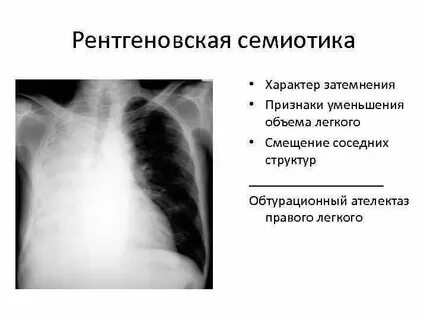 Сужено легкое