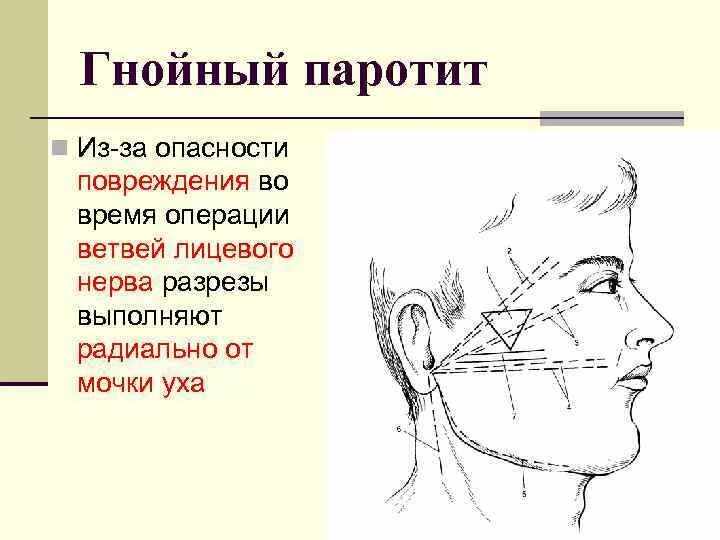 Паротит околоушной слюнной железы. Разрезы при паротитах топографическая анатомия. Разрезы при Гнойном паротите. Разрезы при операциях на околоушной слюнной железе. Операции околоушная железа