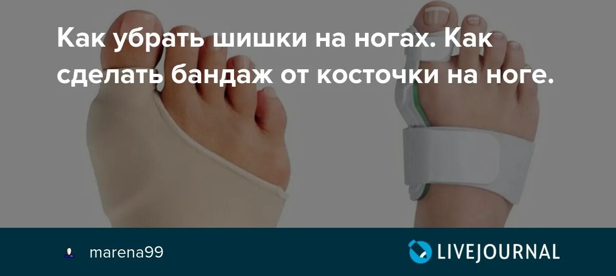 Как убрать шишку у ребенка. Скобы от шишек на ногах. растет косточка на ногах бандаж. как убрать шишки косточки на ногах.