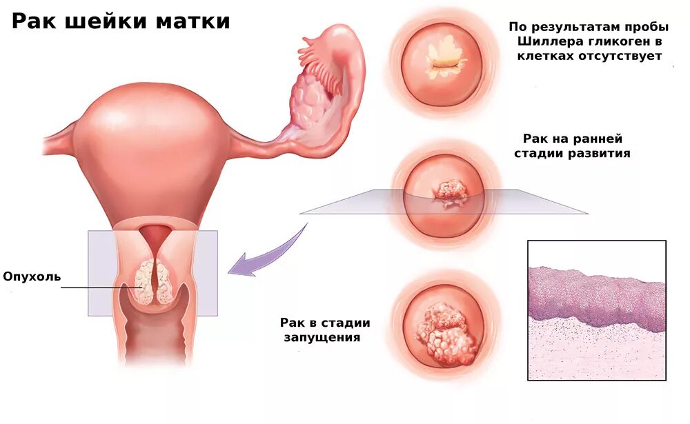 Как выглядит рак шейки матки Ung thư cổ tử cung: Lưỡi hái tử thần của chị em phụ nữ