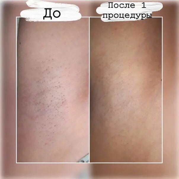 Сколько нужно сеансов лазерной эпиляции. Лазерная депиляция результат. после 8 процедуры лазерной эпиляции. лазерная эпиляция лица результат после 1 процедуры. результат уже после первой процедуры.