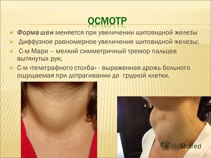 Увеличенная щитовидная железа. Изменения шеи при щитовидке. Увеличенная щитовидная железа у женщин. Как жить без щитовидной железы