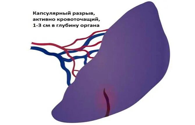 Селезенка жалобы. Повреждение селезенки. Спленомегалия мкб.