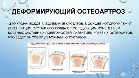 Симптомы деформирующего остеоартроза