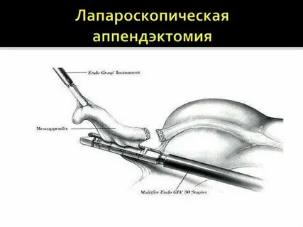 Что можно в больницу после аппендицита