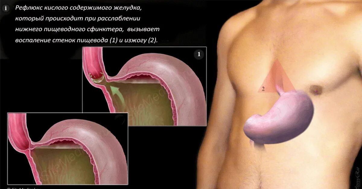 Ощущение желудка причины. Заболевание желудка рефлюкс. Гастрит рефлюкс эзофагит. Хронический неэрозивный рефлюкс эзофагит.