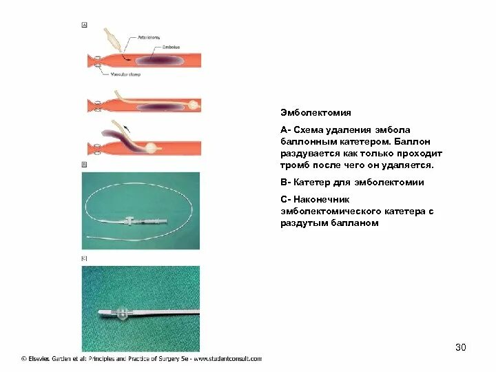 Катетер баллонный для тромбэктомии. Катетер Фогарти бронх. Балонный катетер для сосудов. После катетера больно