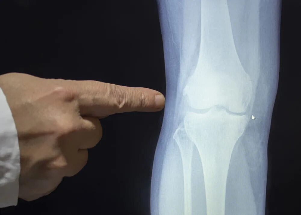 Рентген колена. Рентген коленного сустава. Снимки коленного сустава.