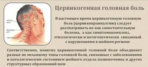 Невралгия шеи лечение