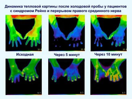 Вибрационная болезнь 2 степени
