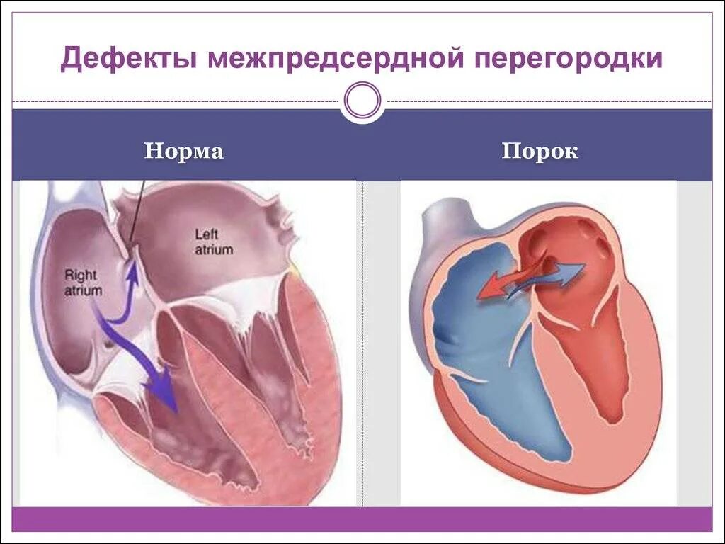 Окно в сердце у новорожденного