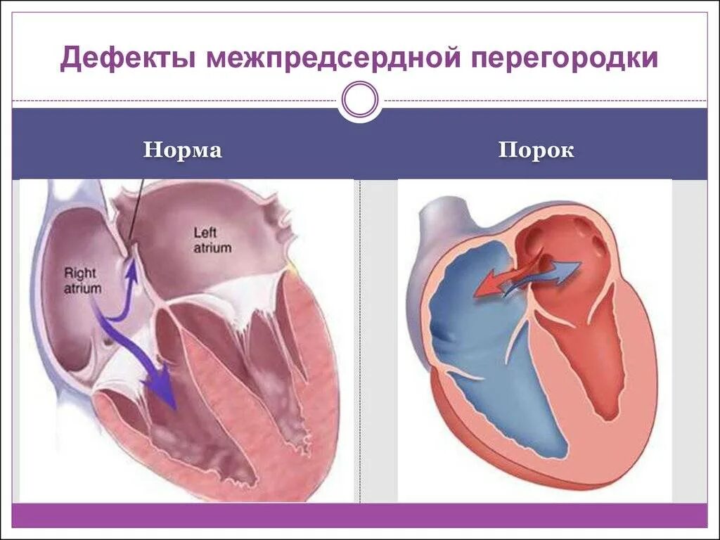 Аневризма перегородки у ребенка. Порок сердца межпредсердной перегородки. Дефект межпредсердной перегородки нормы. Первичный дефект межпредсердной перегородки. Дефект межпредсердной перегородки (ДМПП).