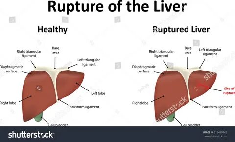Rupture Liver Stock Illustration 312430742.