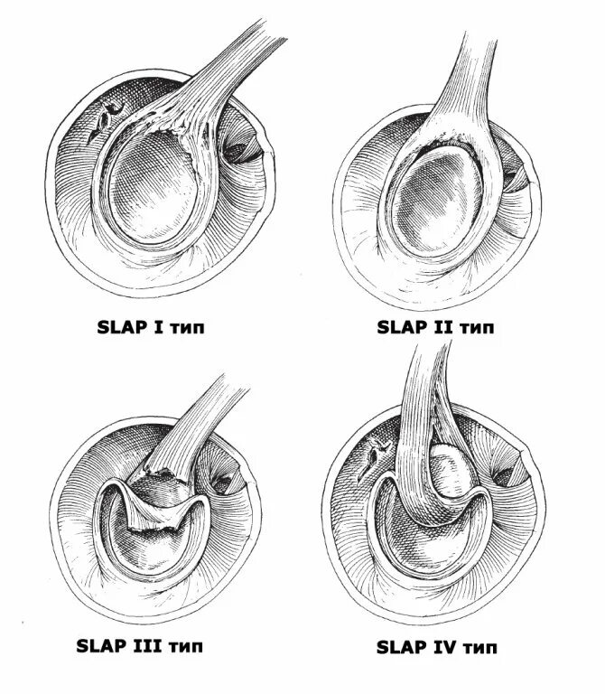 Слап повреждение плечевого сустава. Повреждение слэп плечевого сустава мрт. Slap повреждение плечевого.