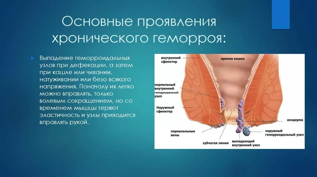 Выпадение геморроидальных узлов. Хронический внешний геморрой. Хронический геморрой симптомы. Боли внутри заднего прохода