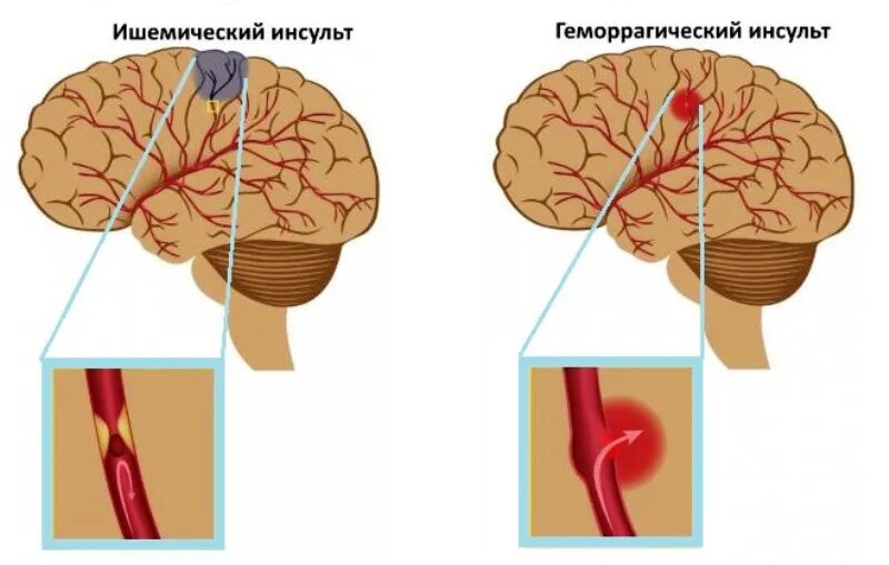 Что такое ишемический инсульт головного мозга. Ишемический и геморрагический инсульт. Ишемический инсульт мозга. Ишемический и геморрагический инсульт головного мозга. Типы геморрагического инсульта.