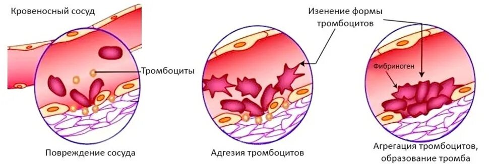 Стадии образования тромба схема. Механизм образования тромба схема. Тромбоциты образование тромба. Этапы образования тромба в кровеносном сосуде.