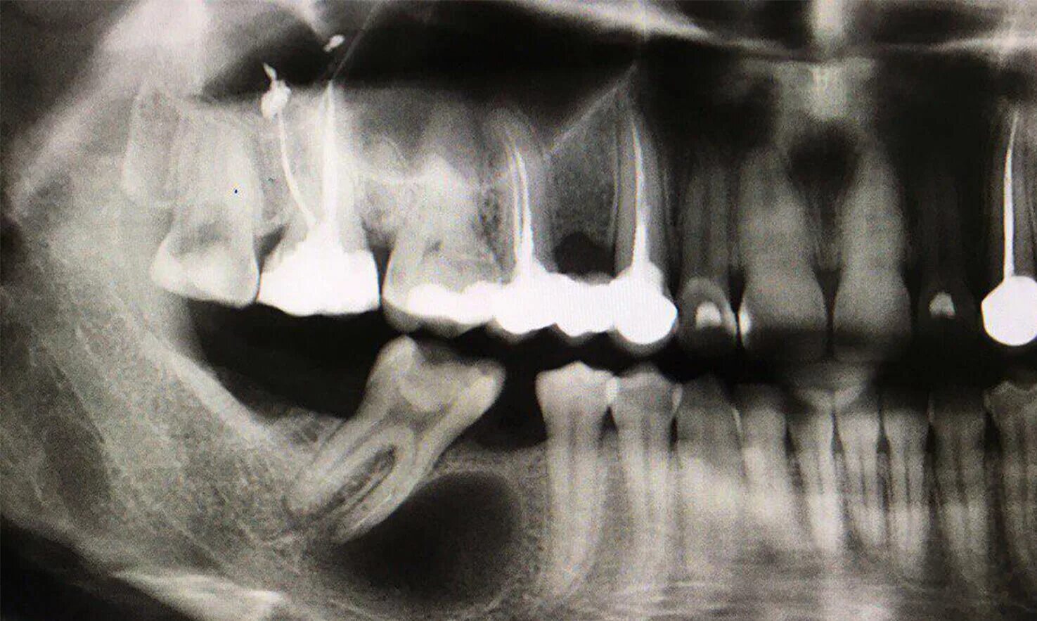 Снимок зубов видное. Ортопантомограмма кариес. Хронический периодонтит на ортопантомограмма. Рентген ОПТГ зубных рядов.