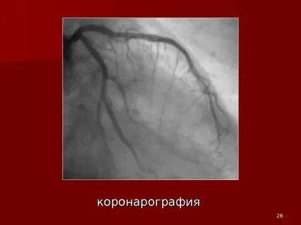 После коронарографии