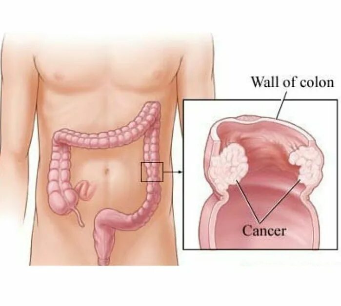 Раковая опухоль кишечника. Новообразования в прямой кишке.
