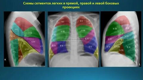 4 сегмент правого легкого