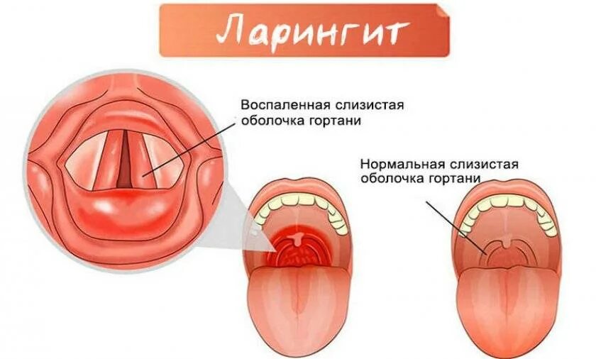 Если сел голос и болит горло. Острый катаральный ларингит профилактика. Пропавший голос. Кашель и пропадает голос у взрослого. Подсвязочный ларингит.