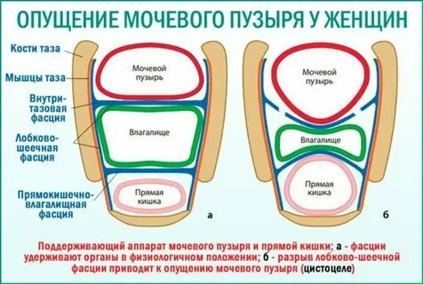 Выпадение органов малого таза у женщин