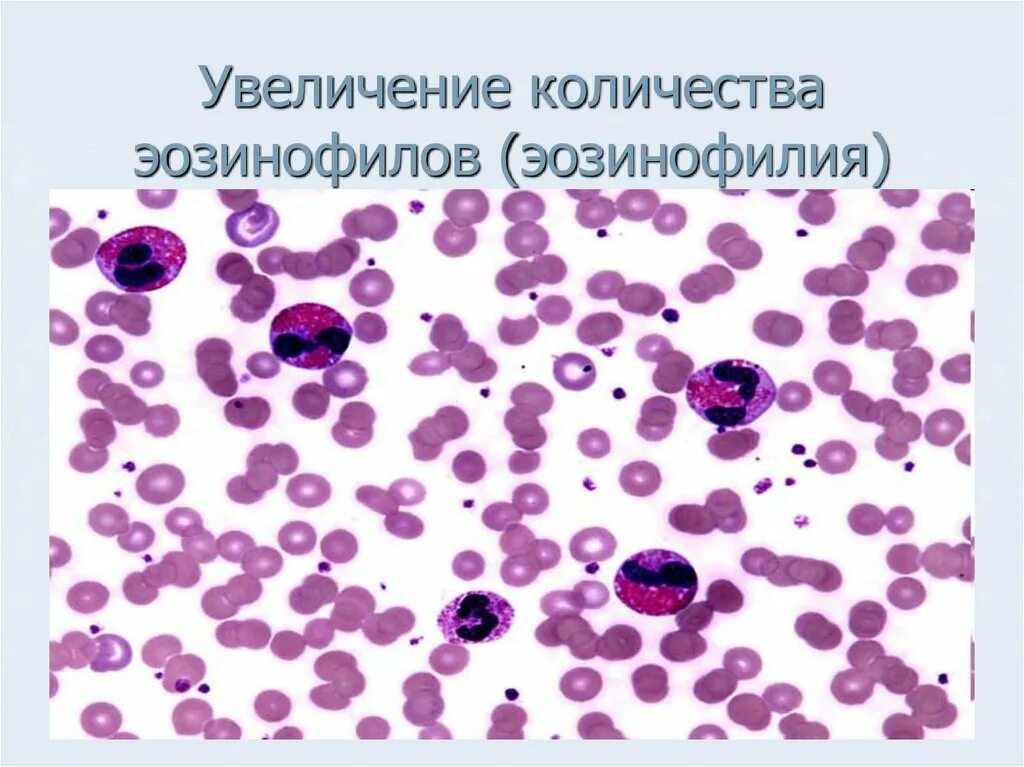 Эозинофильный лейкоцитоз патогенез. Эозинофильный лейкоцитоз картина крови. Механизм развития эозинофильного лейкоцитоза. Эозинофил Электронограмма. Эозинофильный лейкоцитоз