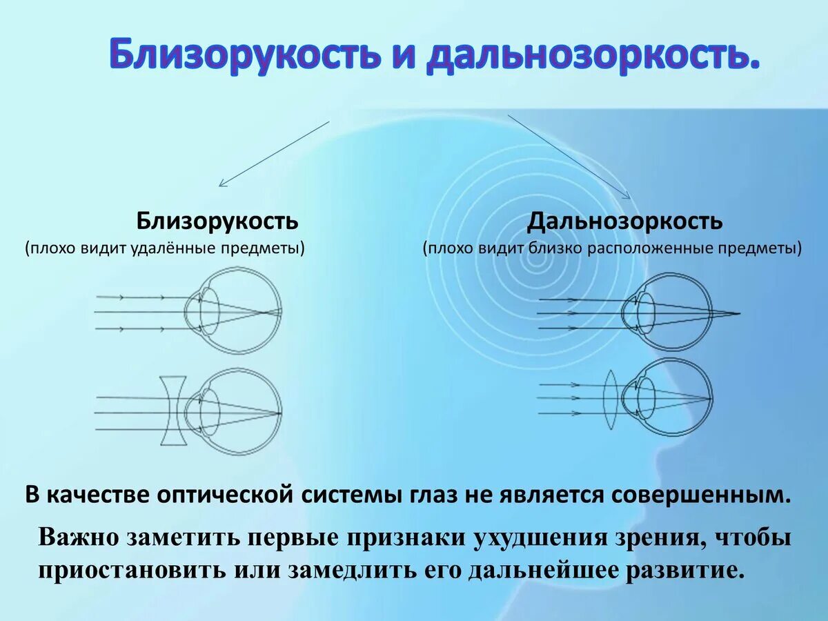 Дальнозоркость линзы двояковыпуклые. Нормальное зрение дальнозоркость близорукость. Нарушение зрения близорукость дальнозоркость. Миопия и гиперметропия. Близорукость это миопия а дальнозоркость это.