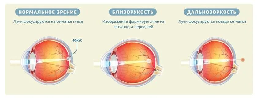 Миопия глаза высокой степени. Миопия схема глаза. Нормальное зрение близорукость дальнозоркость схема. Что такое близорукость (миопия) и дальнозоркость (гиперметропия). Форма глаза при близорукости и дальнозоркости.