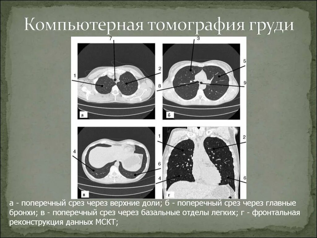 Фронтальный срез кт. Срезы кт. Срезы кт. Компьютерная томография срезы. Аксиальный срез кт.