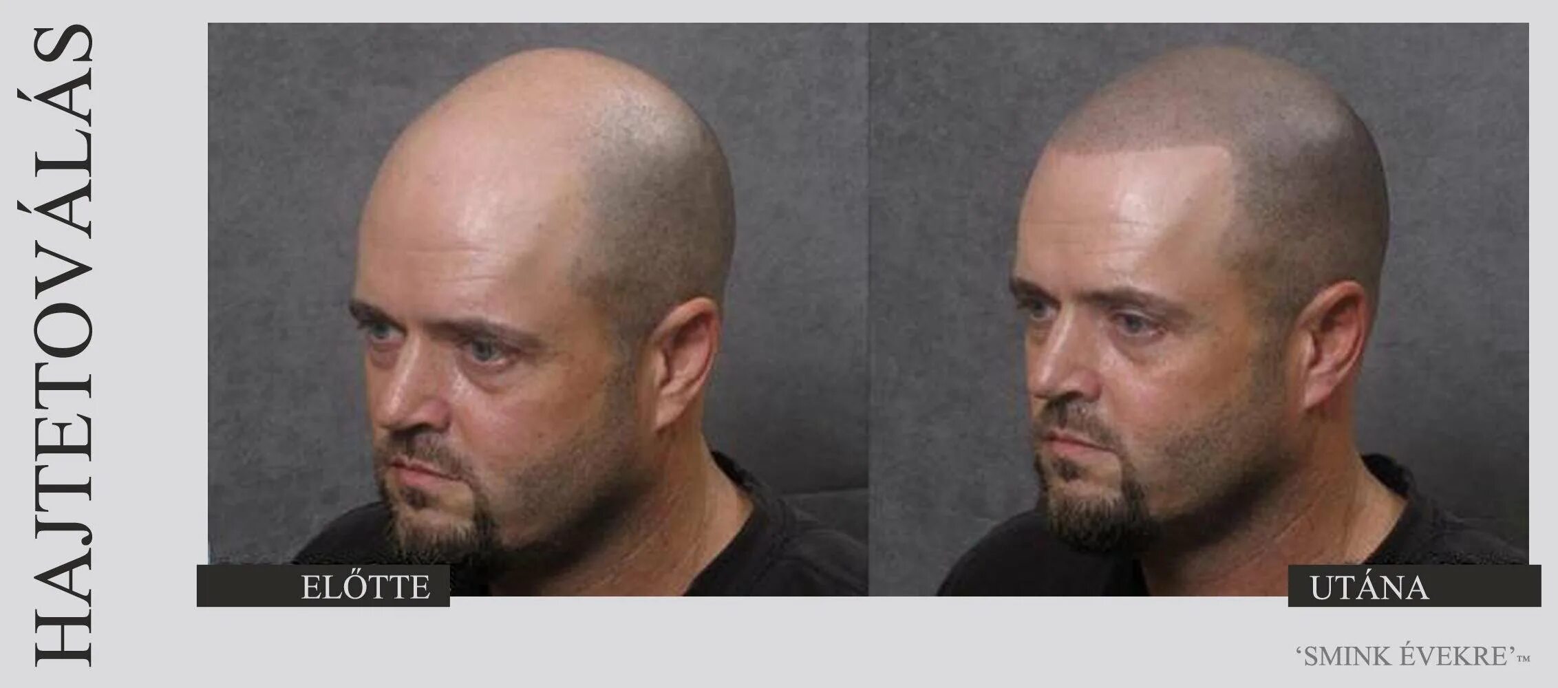 зачес лысины сзади вперед. ленин владимир ильич в молодости. лысина ленина. с чем сравнивали лысину ленина. ленин владимир ильич лысый.