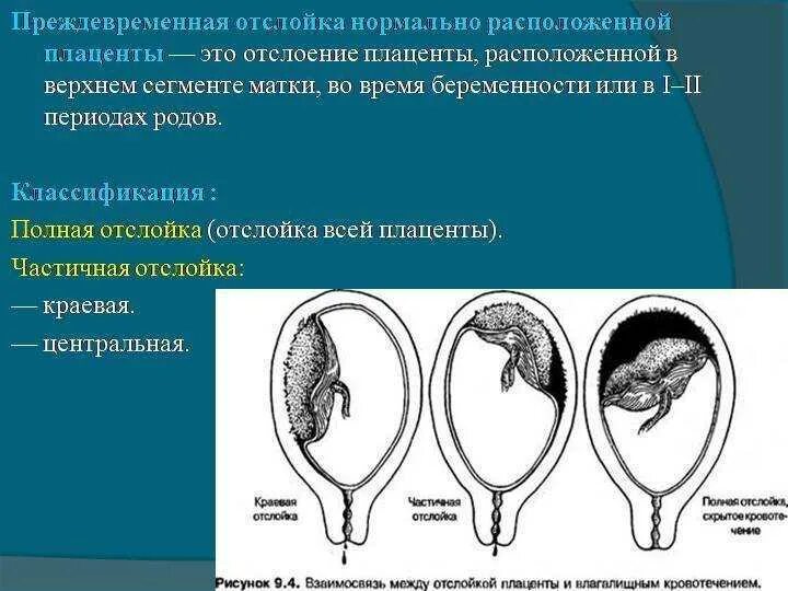 Отслойка хориона на ранних сроках. Преждевременная отслойка плаценты классификация. Полная преждевременная отслойка нормально расположенной плаценты. Ретроплацентарная отслойка плаценты. Преждевременная отслойка плода симптомы.